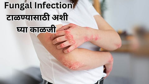 Fungal Infection During Monsoon