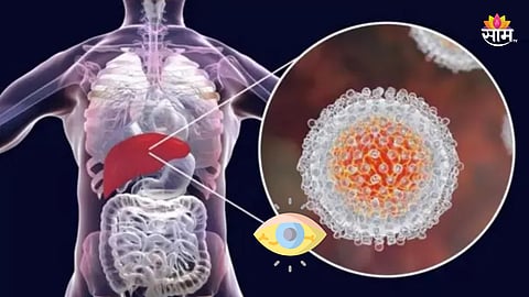 Kavil Symptoms: जीवघेणी ठरतेय पांढरी कावीळ, जाणून घ्या काय आहे कारण?