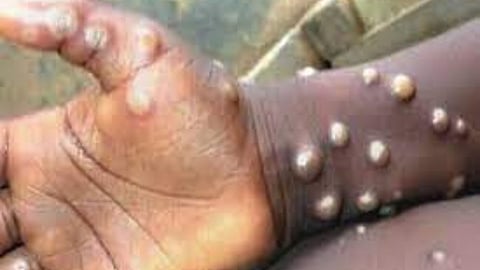 Monkeypox: मंकीपॉक्सची दहशत; केंद्र सरकारच्या सर्व राज्य सरकारांना मार्गदर्शक सूचना