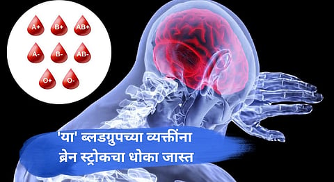 Blood Type and Brain Stroke