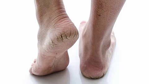 Heal Cracked Heels