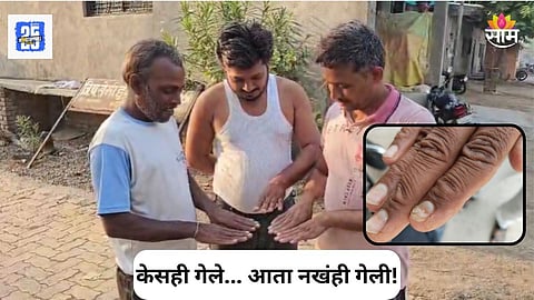 Buldhana News: बुलढाण्यात चाललंय तरी काय? केस गळतीनंतर आता बोटांची नखंही गेली, गावकऱ्यांमध्ये भीती कायम