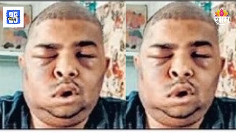 Hair Transplant