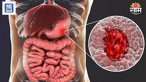 Stomach Ulcer Symptoms
