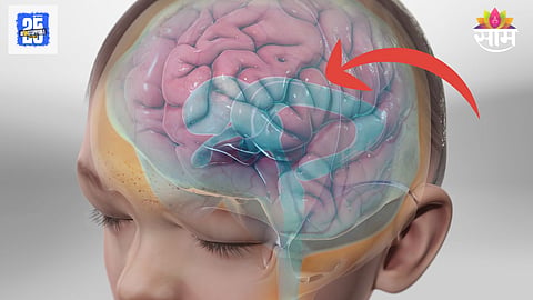 Brain fluid accumulation symptoms