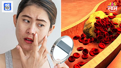High cholesterol symptoms on face