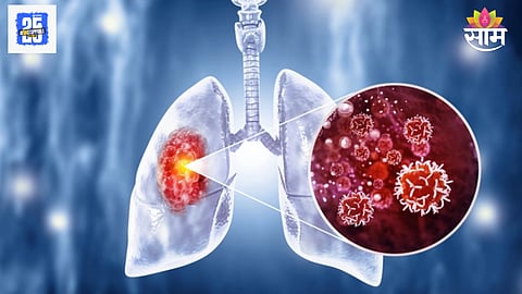 Early signs of lung cancer