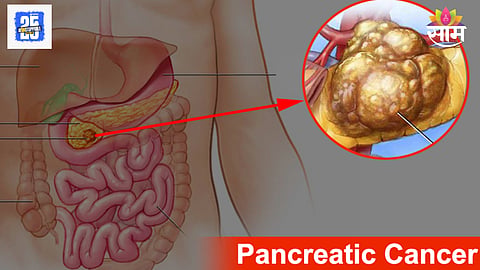 Early symptoms of pancreatic cancer