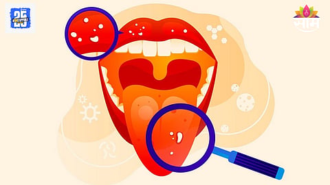 Early signs of oral cancer