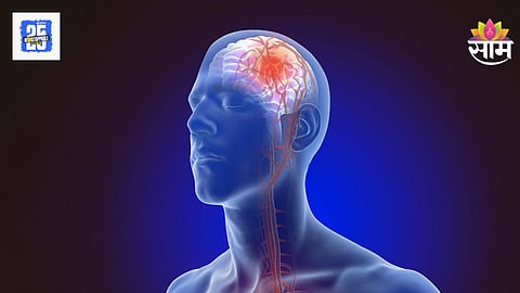 Stroke Symptoms