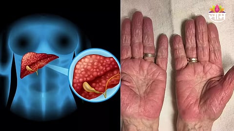 Liver Damage Symptoms