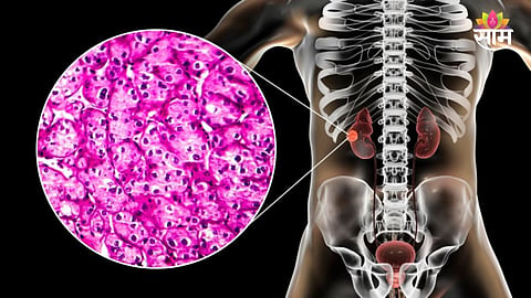kidney cancer 7 symptoms