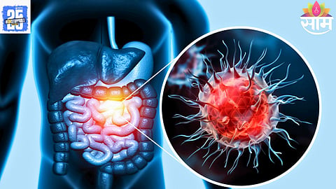 colorectal cancer under 50