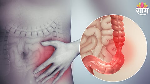 irritable bowel syndrome
