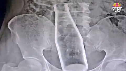 Glass bottle stuck inside body