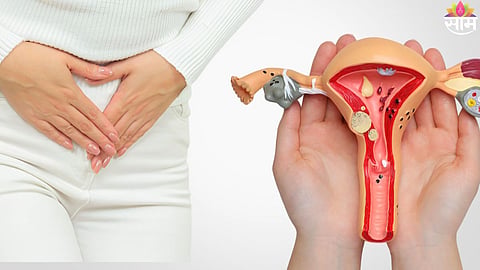PCOS and ovarian cancer symptoms