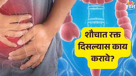 Colon Cancer
