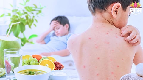 Chickenpox Care
