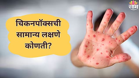 chickenpox symptoms