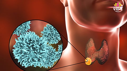 Thyroid disorder