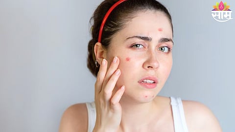 Period Acne Causes