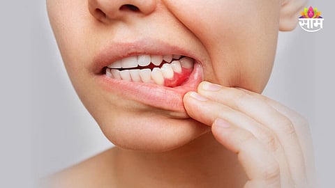Gum Bleeding Causes