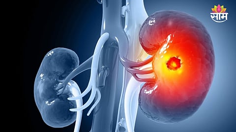 Kidney Cancer