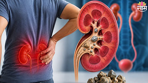 Kidney Stone Symptoms