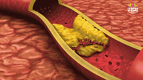 Coronary artery disease