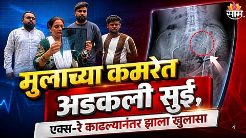 KDMC RUKMINIBAI HOSPITAL NEGLIGENCE: NEEDLE LEFT INSIDE 2.5-YEAR-OLD BOY AFTER RABIES INJECTION
