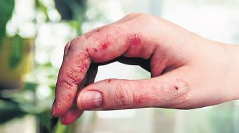 eczema