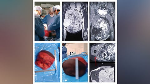 Tumor