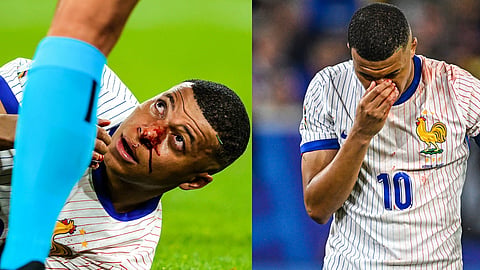 Kylian Mbappé suffers broken nose and is doubt for game against Netherlands
