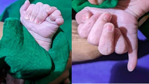 Baby born with 13 fingers and 12 toes in Karnataka
