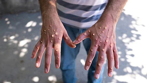 mpox