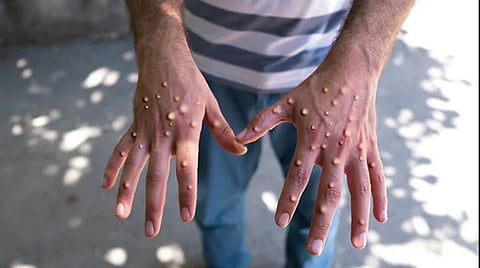 vaccine
