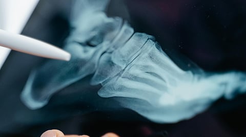 bone health