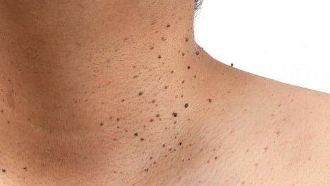 skin tags