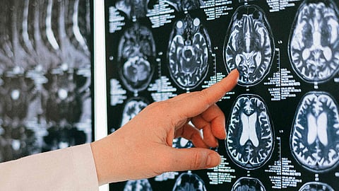 Parkinson's disease