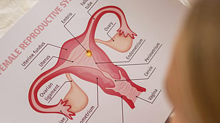ovarian cancer