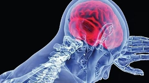 Encephalitis