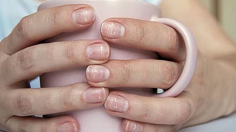 Leukonychia in hand nails