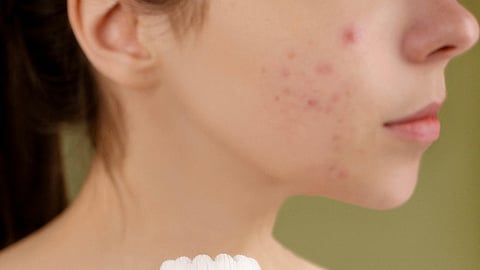 Pimple Issues