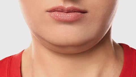 double chin