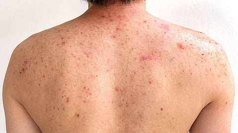 Body Acne