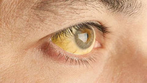 Jaundice