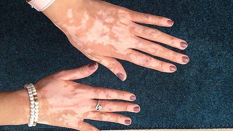 Vitiligo diseases