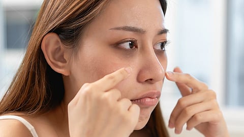 Dark Circle under eye