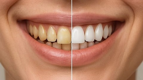yellow teeth causes