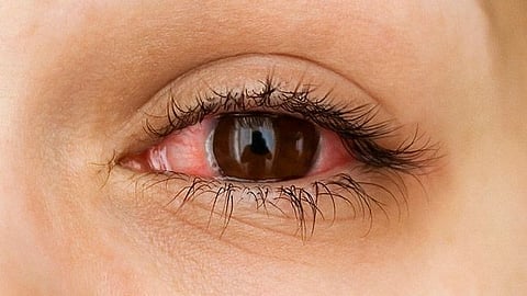 bloodshot eyes